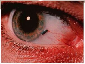 foreign body in the eye