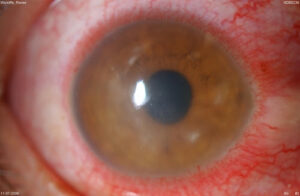 mikroviaki keratitida