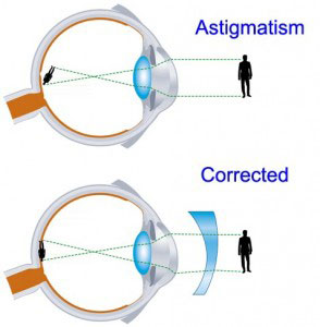 astigmatismos 2 georgios lamprakis xeirourgos ofthalmiatros ioannina